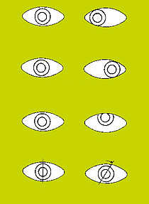 Grafische afbeelding van scheelzien met verschillende afwijkende standen van de ogen